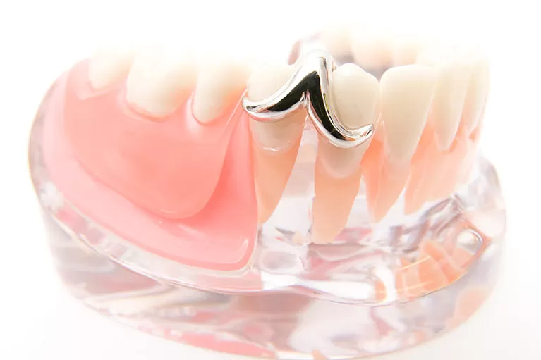 ノンクラスプデンチャー（自費診療）